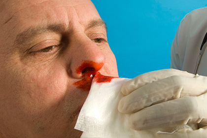 Найден простой способ устранения кровотечения из носа